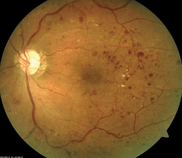 Estrutura da retina e enfermidades comúns da retina