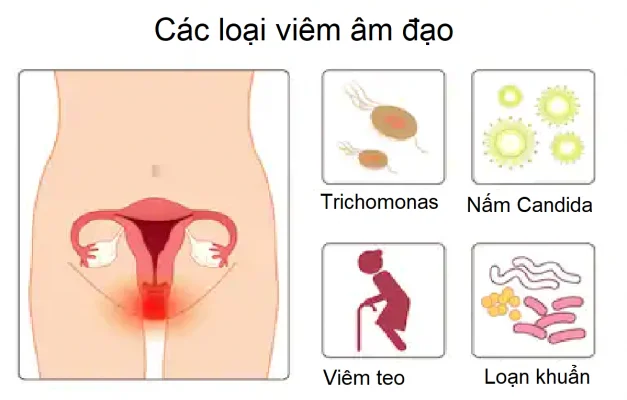 Vaginiit: kõik, mida pead teadma
