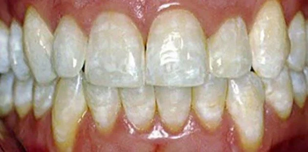 Branqueamento dos dentes e métodos populares hoxe