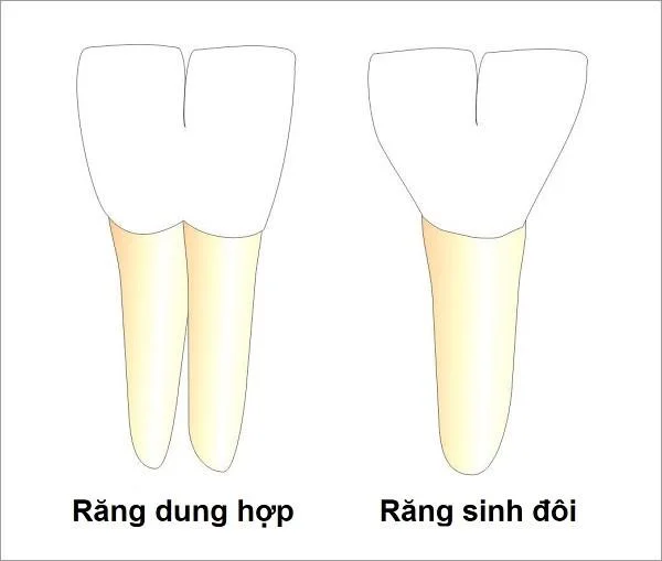 Cousas a ter en conta sobre as anomalías na dentición e o desenvolvemento dos dentes nos nenos