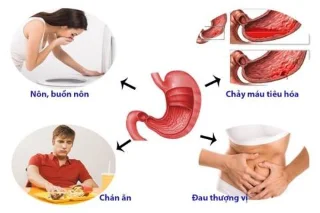 Hyvin perushuomautuksia gastroskopiasta
