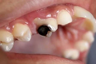 Que é a caries? Causas, tratamento e prevención