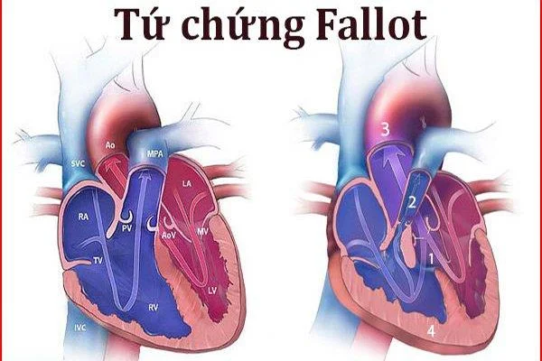 Tetralogi af Fallot: Den mest almindelige cyanotisk medfødte hjertesygdom