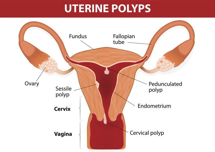 Menorrhagia: Það sem þú þarft að vita!