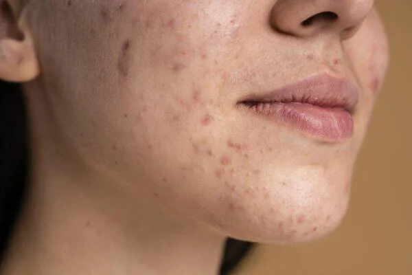 És bo esprémer l'acne?  Conseqüències greus quan esprem l'acne de la manera equivocada