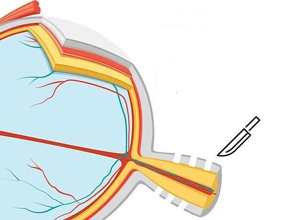 Enfermidade cerebral pseudotumoral: causas, diagnóstico e tratamento