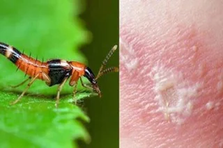 Tratamento e prevención da dermatite de contacto causada por formigas