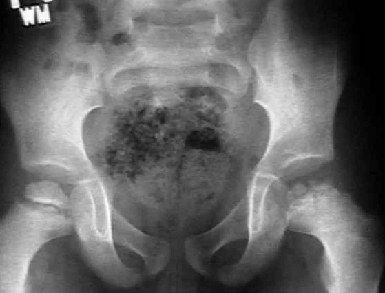 Puusaliigese esmane osteoartriit: põhjused, diagnoos ja ravi