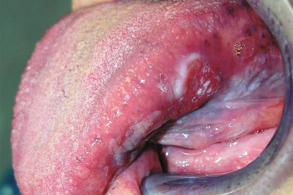 Cancro bucal: o perigo vén dos hábitos cotiáns
