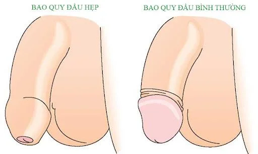 Er omskjæring farlig?