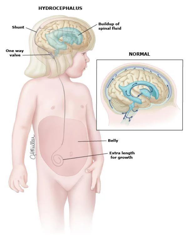 Konvensjonell medisin: Hydrocephalus