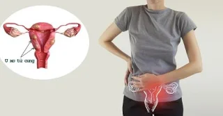 Livmoderfibromer under graviditet er farlige?