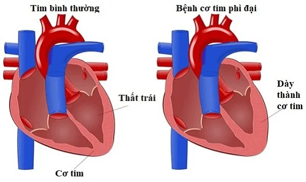 Miocardiopatía hipertrófica: causas, síntomas e tratamento