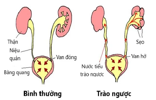 Reflux vesicoureteral: causes, riscos i complicacions