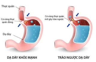 Barretts esophagus: Diagnose og behandling