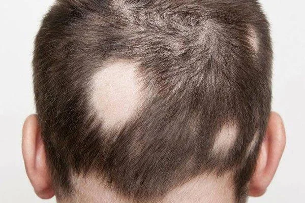 A perda de cabelo é unha enfermidade?
