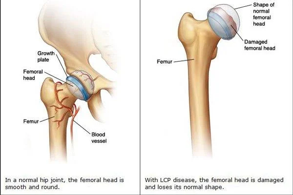 Puusaliigese esmane osteoartriit: põhjused, diagnoos ja ravi