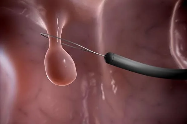 Pòlips uterins: el que has de saber!