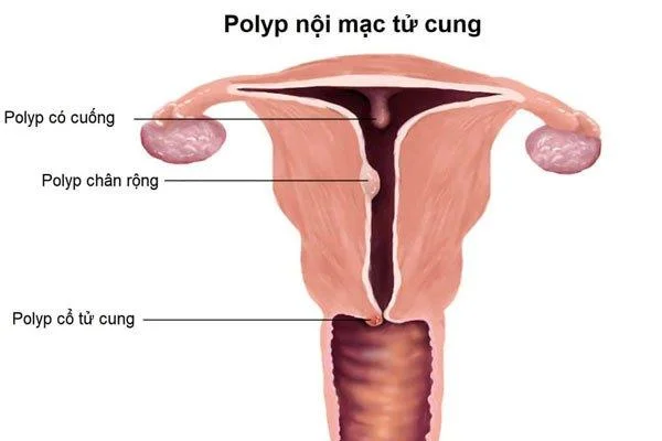 Pòlips uterins: el que has de saber!