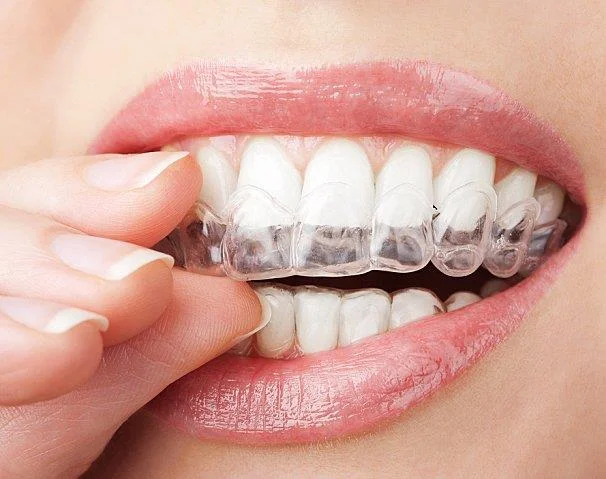 Branqueamento dos dentes e métodos populares hoxe