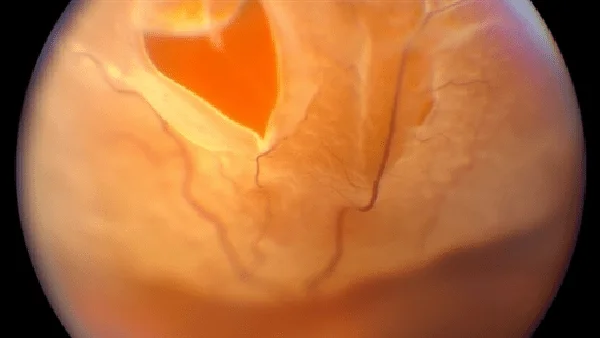 Estrutura da retina e enfermidades comúns da retina