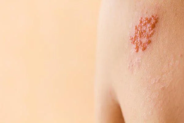 Juostinė pūslelinė: priežastys, simptomai ir diagnozė