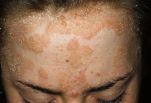 Psoriasis: Orsakir, einkenni, meðferð