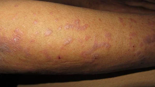 Vad du behöver veta om Lichen flat disease