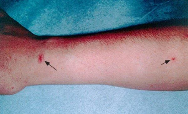 Síndrome hepatopulmonar: definició, signes, diagnòstic i tractament