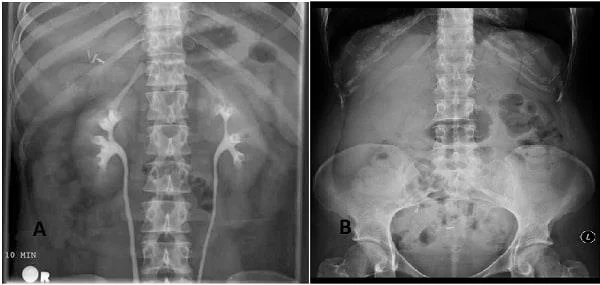 Que é a obstrución ureteral e como che molesta?