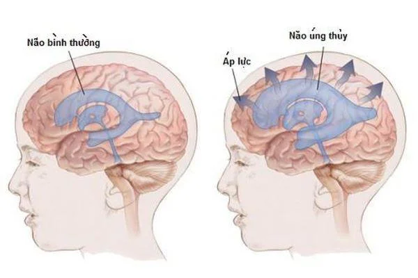 Konvensjonell medisin: Hydrocephalus