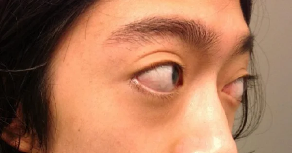 Hyperthyroidisme: Årsager, symptomer og behandling
