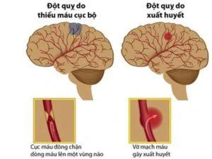 Demencia vascular: causas, síntomas e tratamento