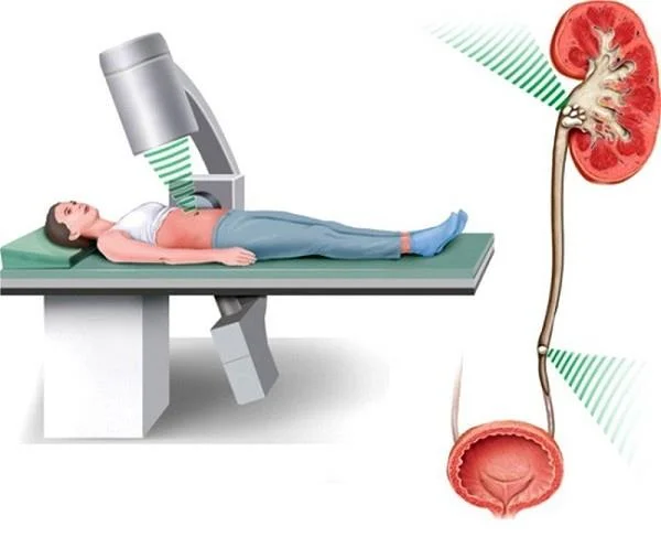 Còlic renal: un dolor que no es pot ignorar