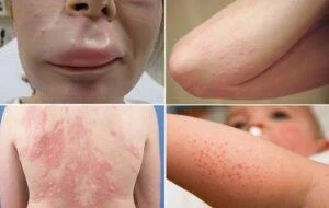 Penicillinallergi: Vad visste du?