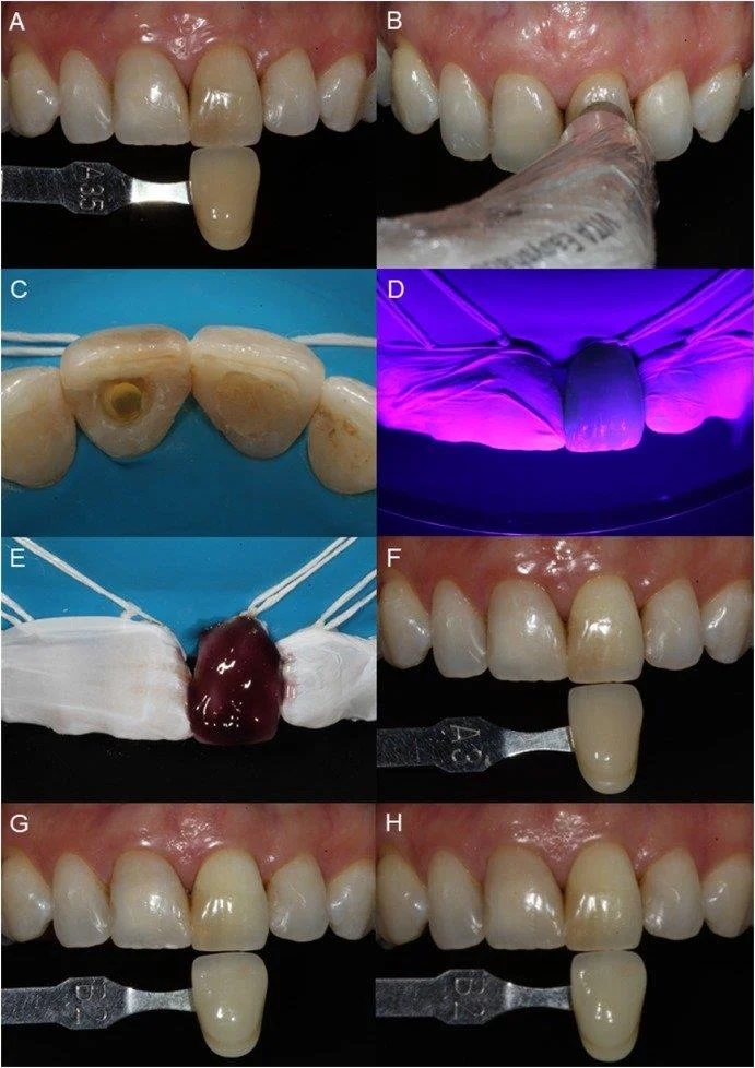 Branqueamento dos dentes e métodos populares hoxe