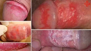 Inflamación do pene: un sinal de advertencia dunha enfermidade perigosa