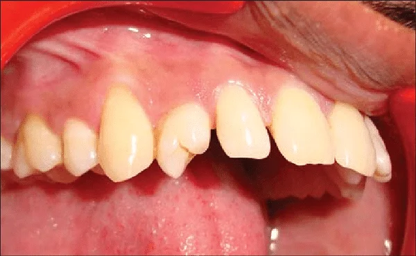 Cousas a ter en conta sobre as anomalías na dentición e o desenvolvemento dos dentes nos nenos