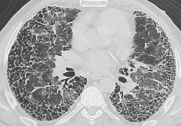 Hvordan behandles lungefibrose?