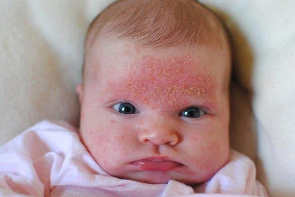 Årsager, symptomer og behandlinger af seborrheic dermatitis