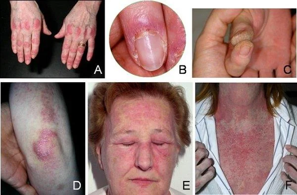 Dermatomiozitas: reta autoimuninė liga, kurią reikia žinoti