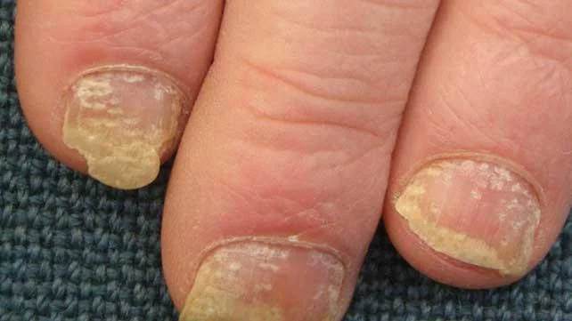 Psoriasis: Orsakir, einkenni, meðferð