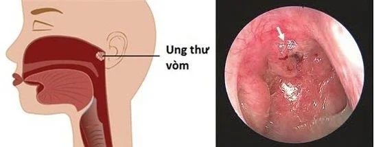 Ganglios linfáticos inchados no pescozo: é cancro?