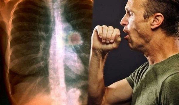 Funktioner, tecken och behandling av tidigt stadium av lungcancer