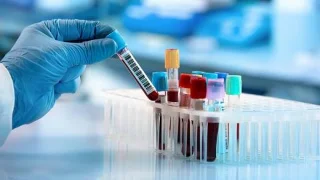 Como se diagnostica e trata a síndrome do ovario poliquístico?