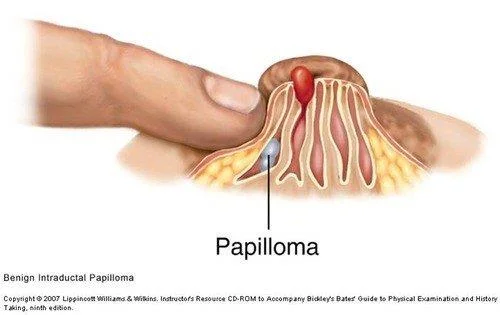 Massa mamària palpable i 7 causes comunes