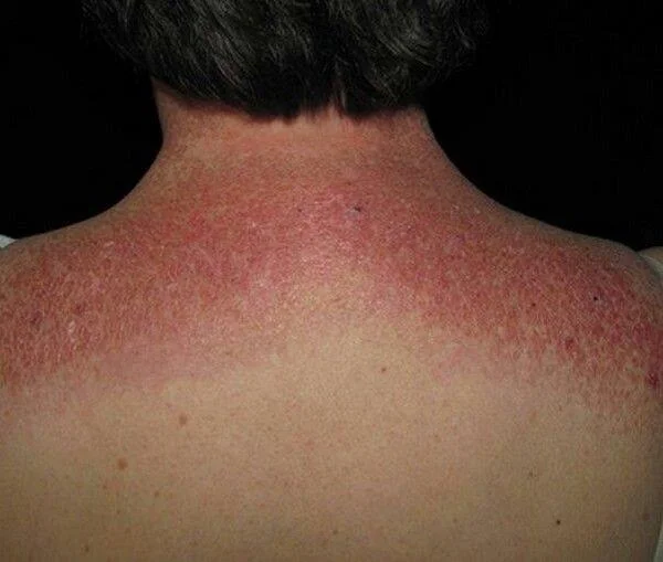 Dermatomiozitas: reta autoimuninė liga, kurią reikia žinoti