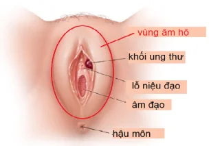 Cancro vaxinal e o que debes saber