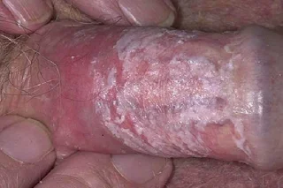 Cal é o sinal da pel do pene?