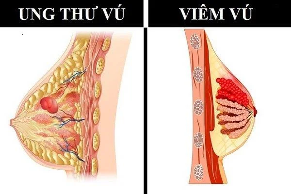 Mastitt og hva legen vil at du skal vite